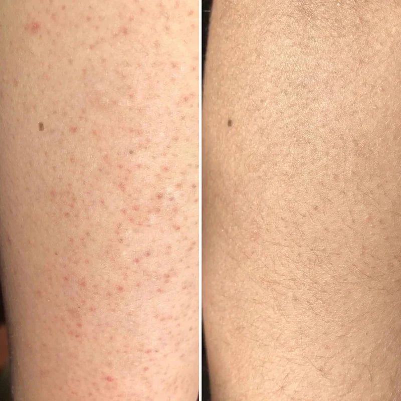 AHA+BHA Exfoliating Bodylotion